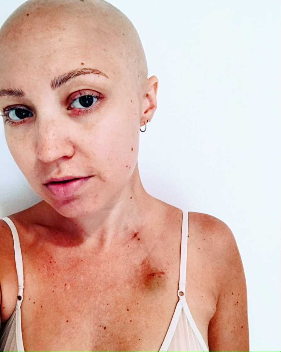 Woman battling aggressive breast cancer takes a selfie, showing off her bald head and bruised chest