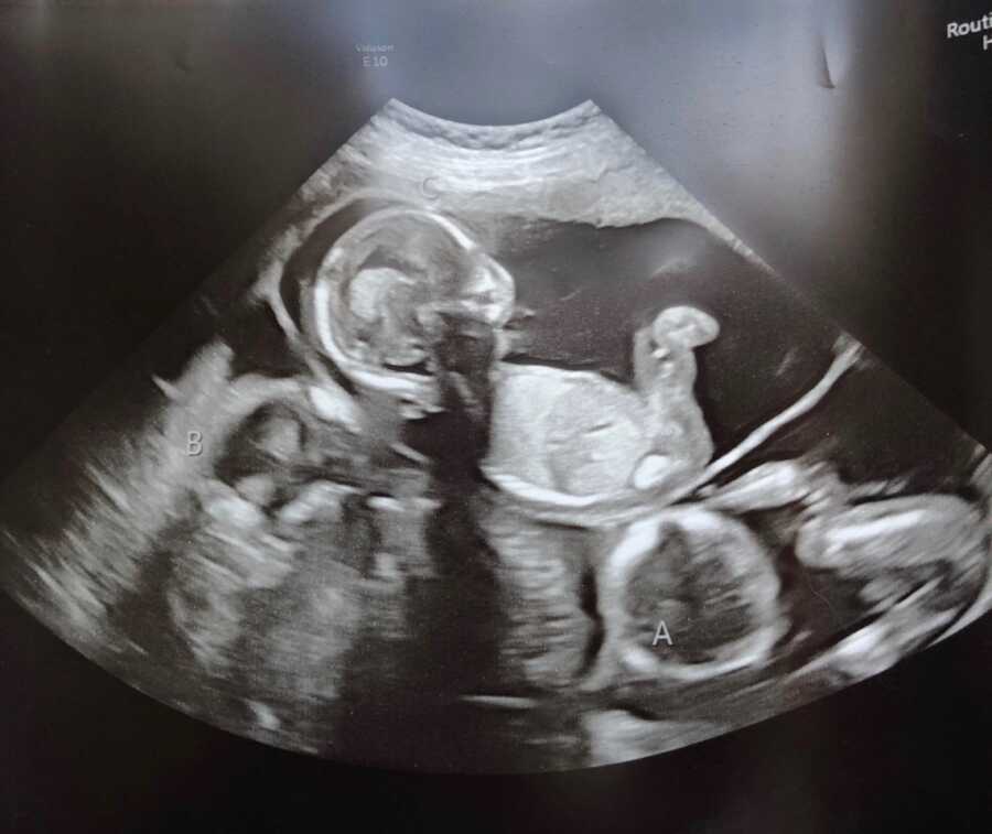 Two moms expecting triplets show an ultrasound with three sacs labeled as Baby A, Baby B, and Baby C