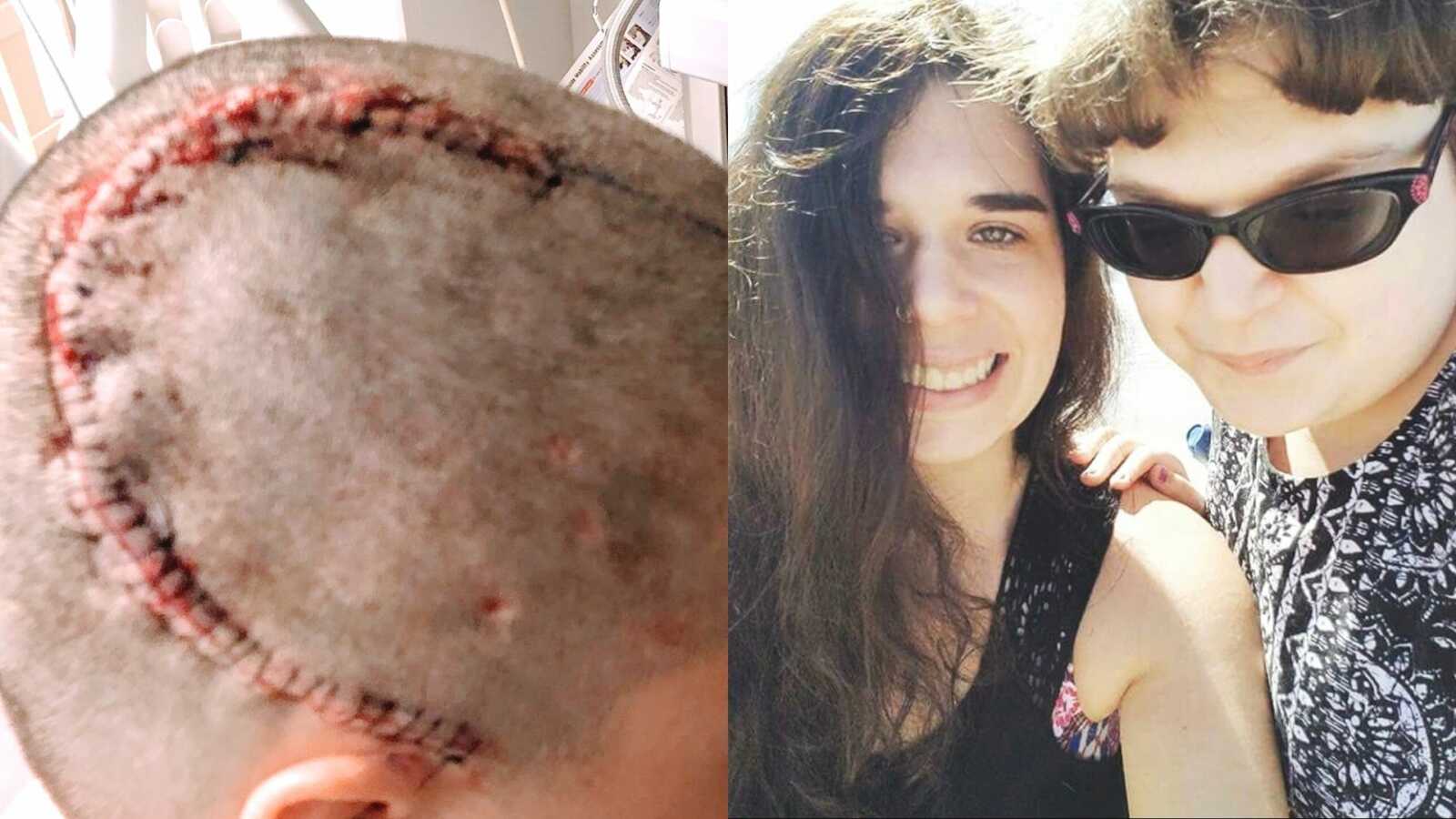 Shaved woman's head after brain surgery and woman with epilepsy with friend