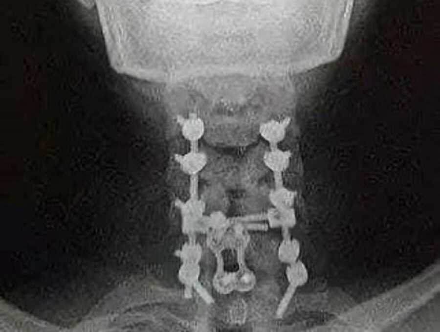 An x-ray image of the break in Fletcher's neck caused by a car accident.