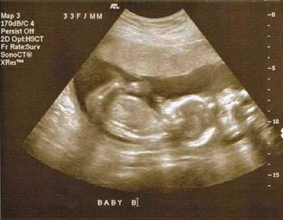 ultrasound picture of twins