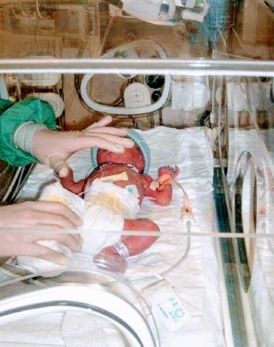 Newborn twin suffering from TTTS