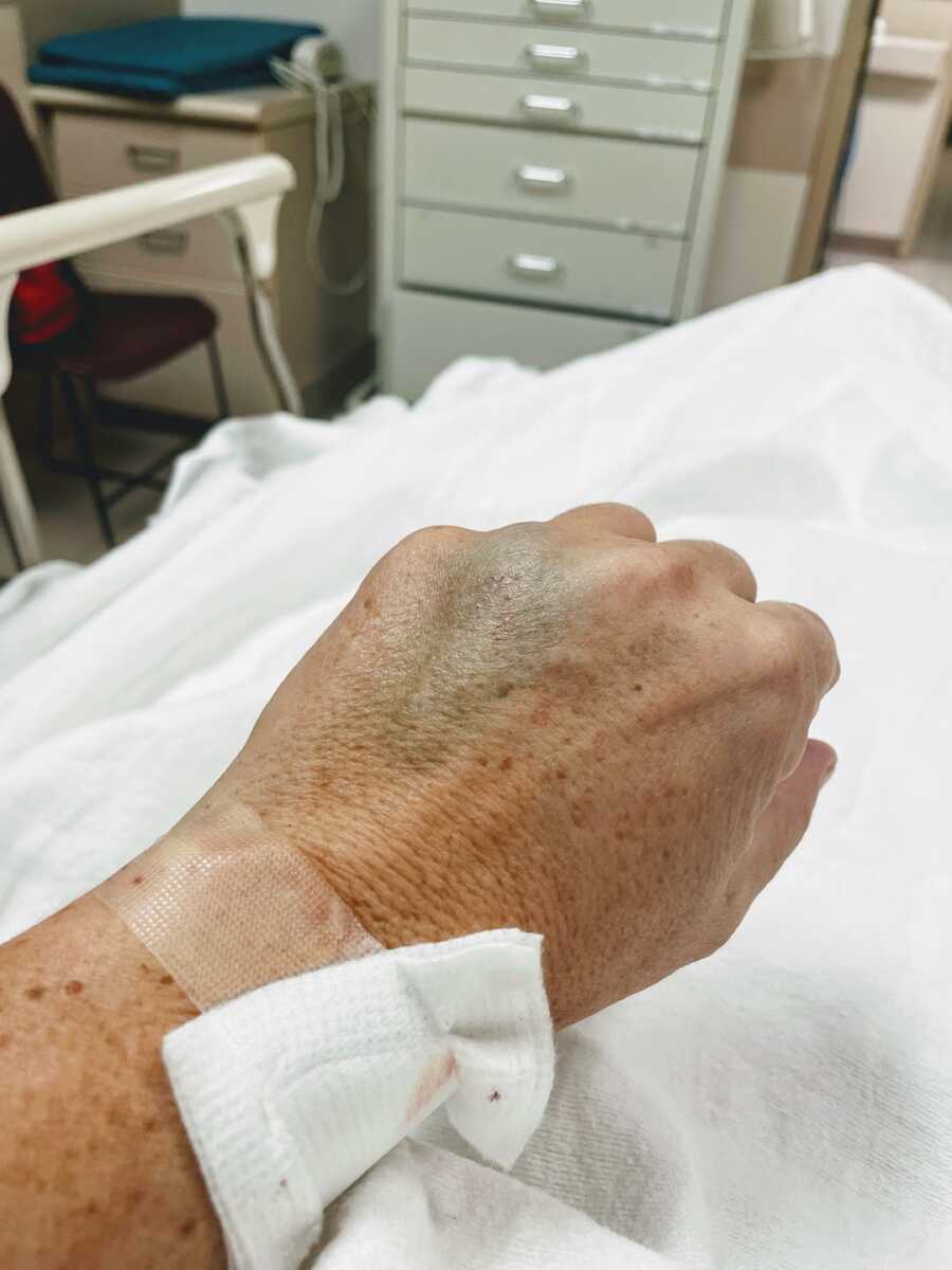 Woman hand is bruised at the ER