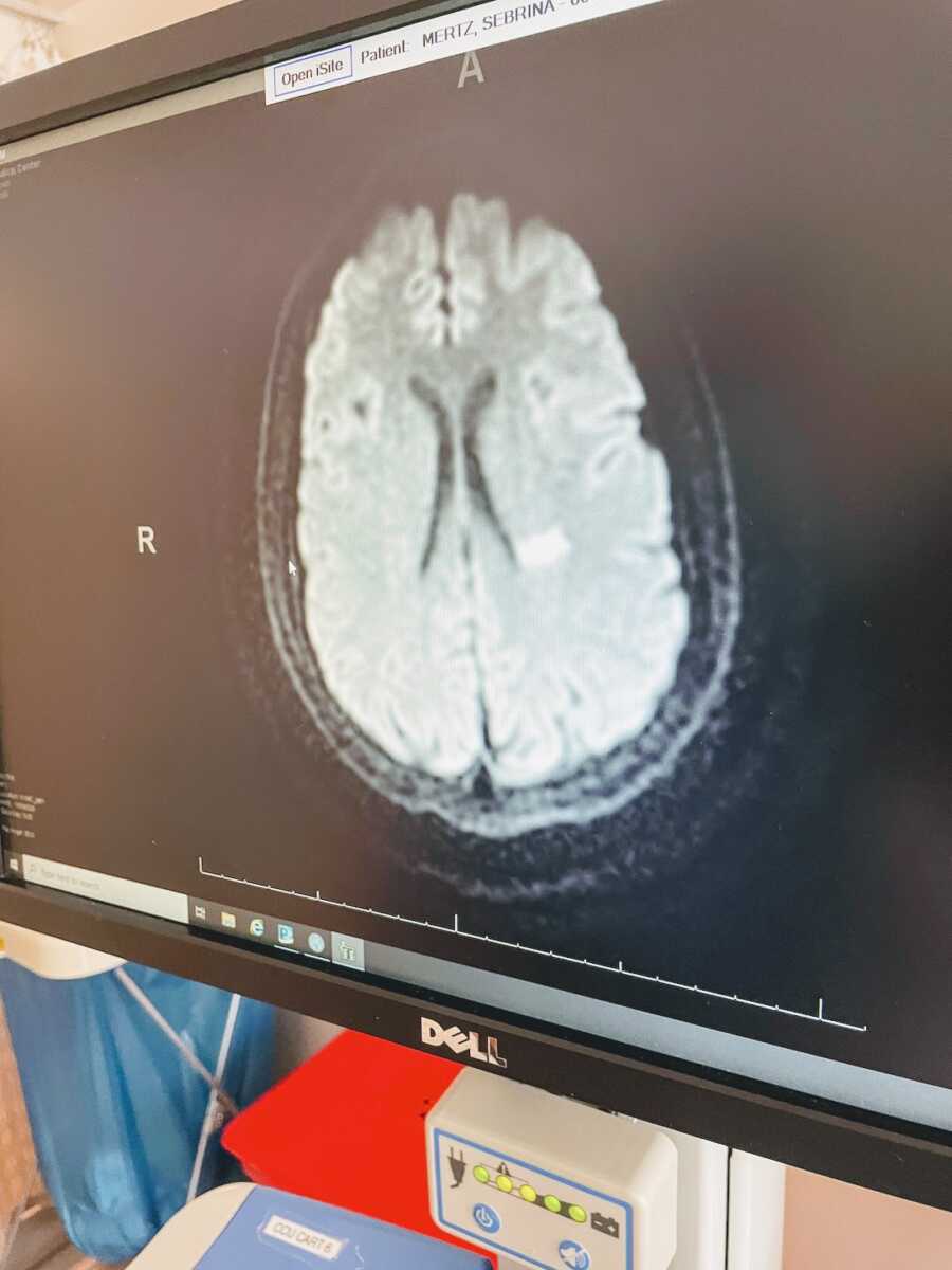 MRI image of a stroke patient's brain