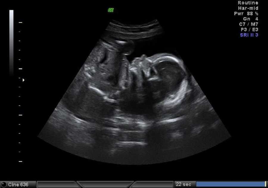 Teen mom takes a photo of an ultrasound of her first child who was breech