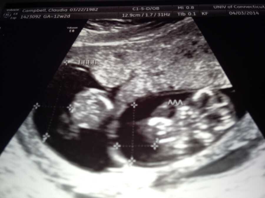 Mom takes a photo of her ultrasound where you can clearly see two sacs