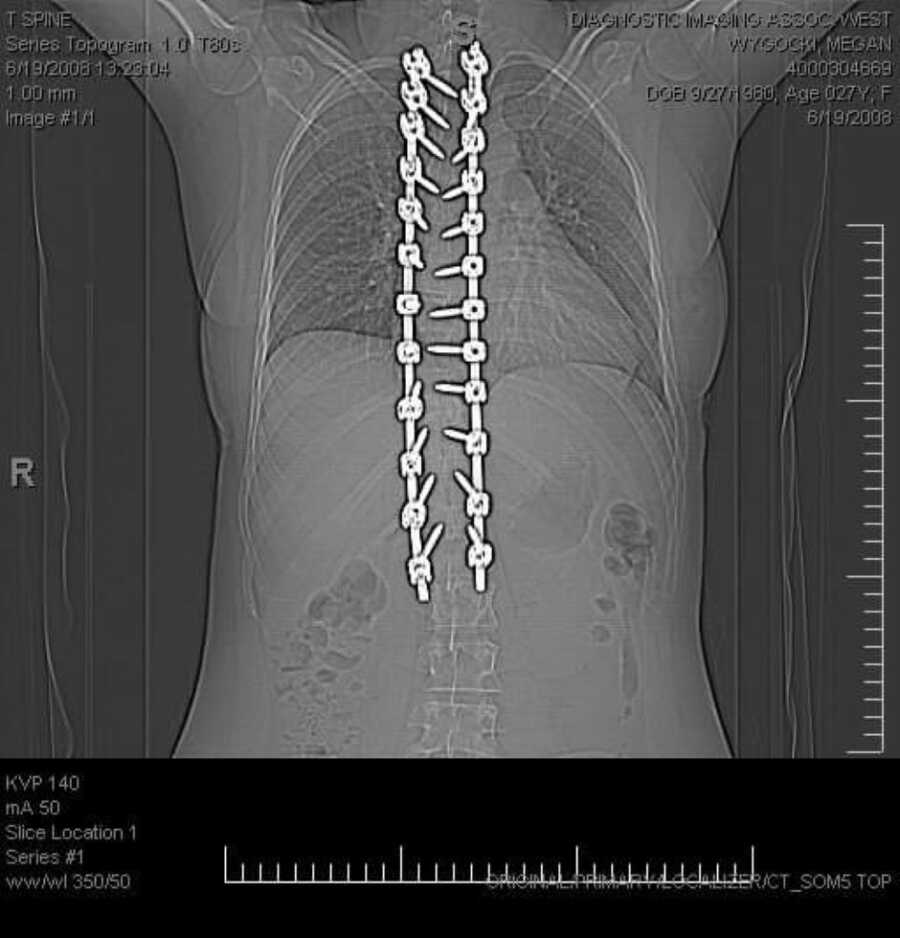 Woman with severe scoliosis undergoes corrective surgery on her spine 