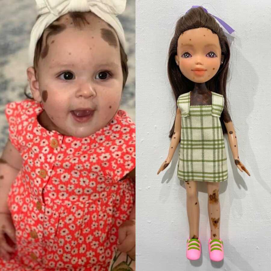a baby girl with a skin defect with her custom doll to show her beauty