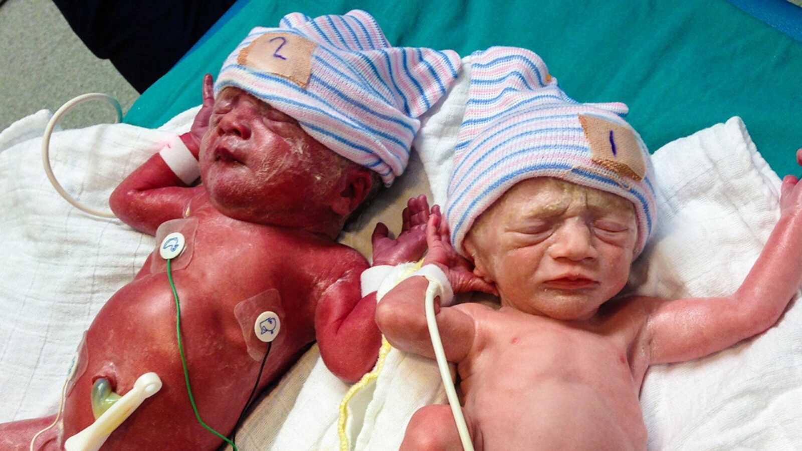 twins with rare disease
