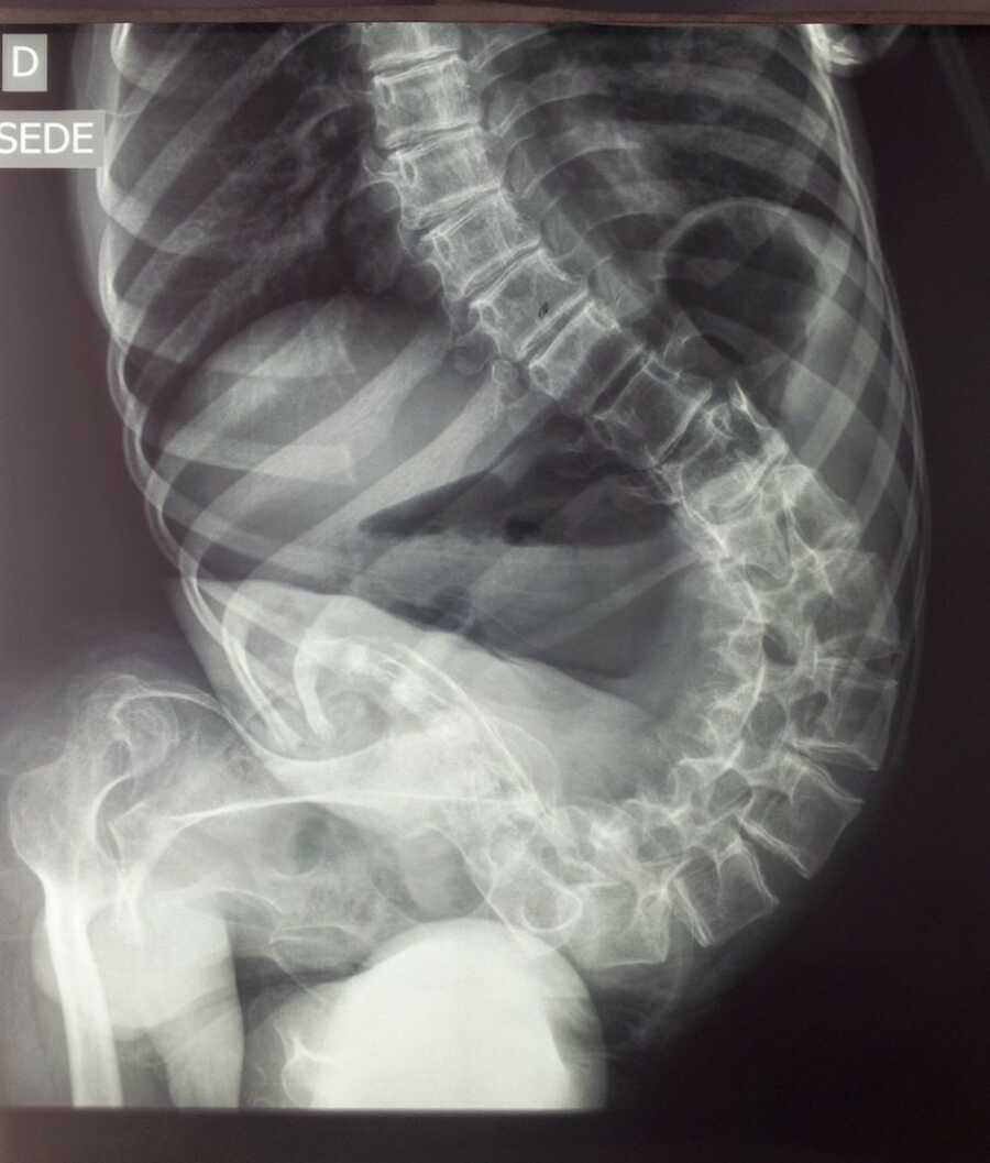 woman's xray of spine