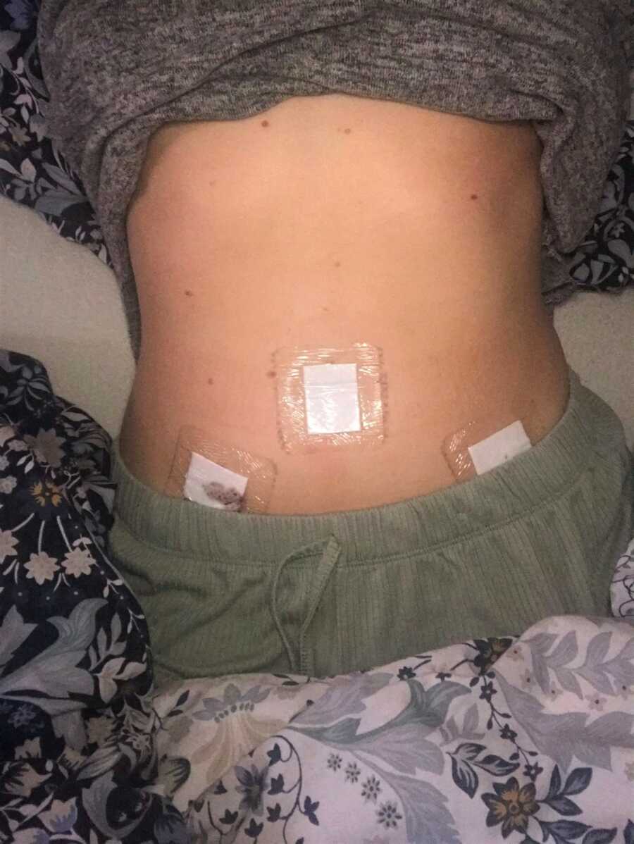 woman showing her abdomen of scars after surgery for cyst