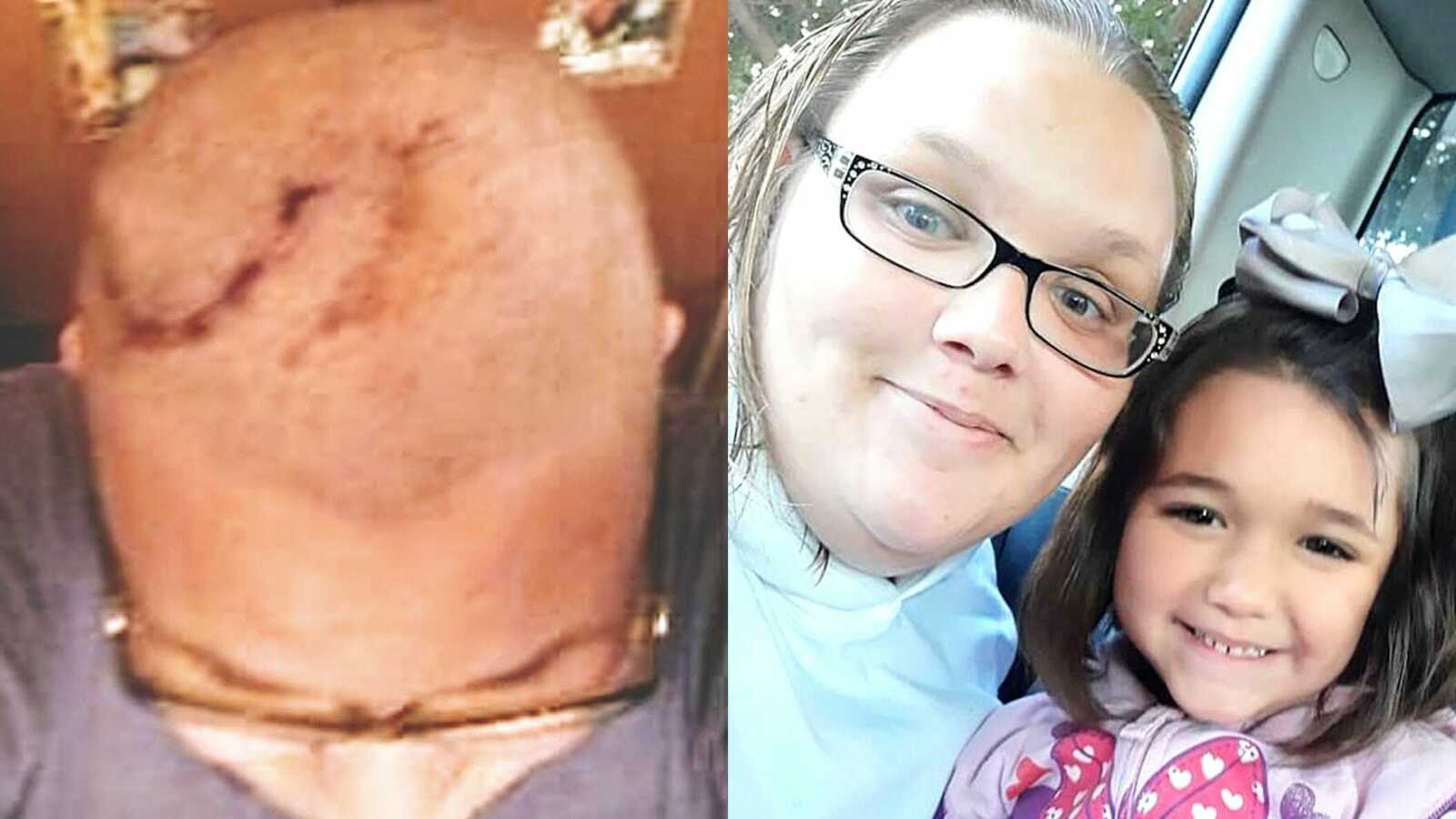 Woman shows surgery scars and brain disease survivor with daughter