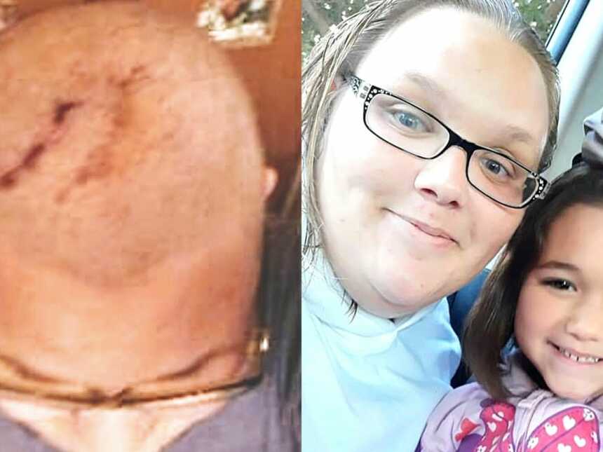 Woman shows surgery scars and brain disease survivor with daughter