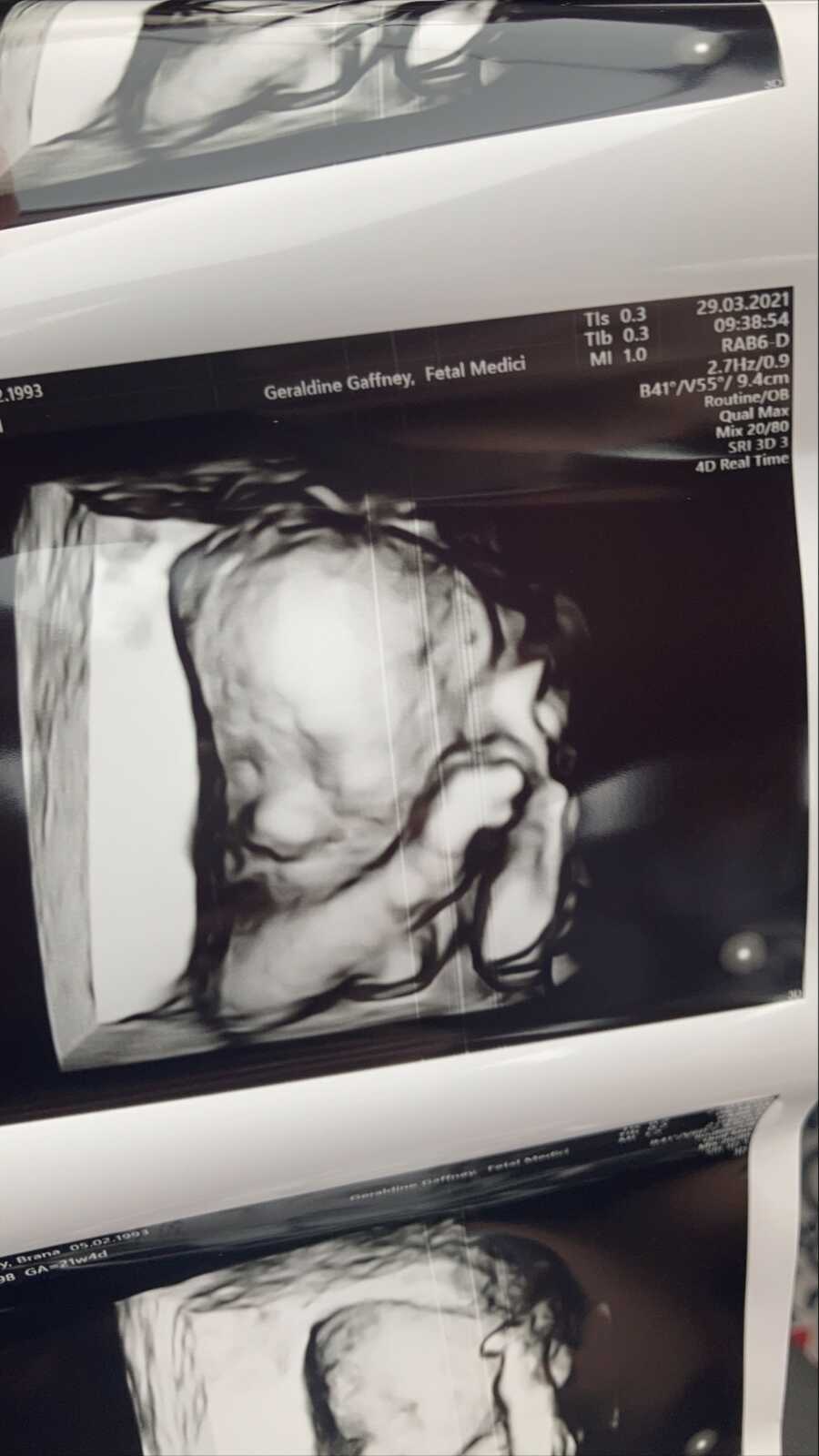 3D ultrasound of baby girl