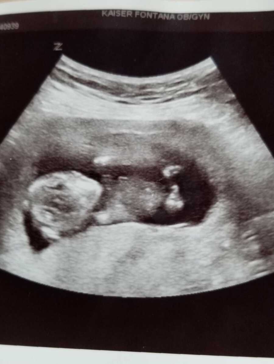 Breinne's ultrasound of baby Sterling. 