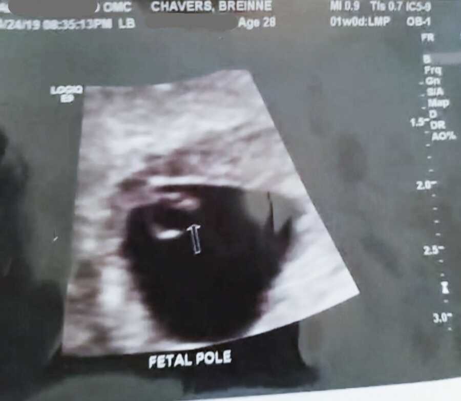 The ultrasound showing baby Sterling at 6 weeks gestation. 