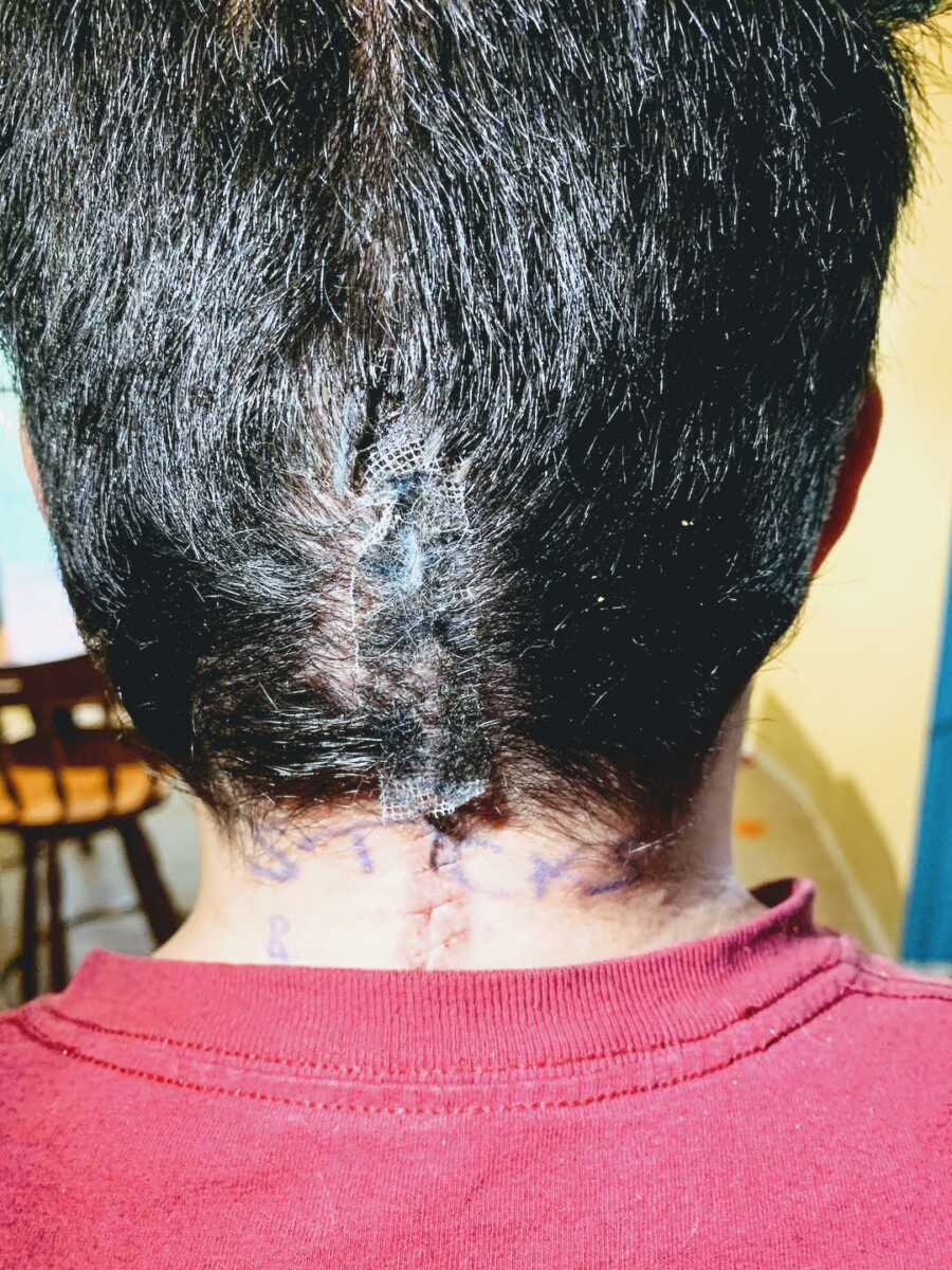 Surgical area healing slowly