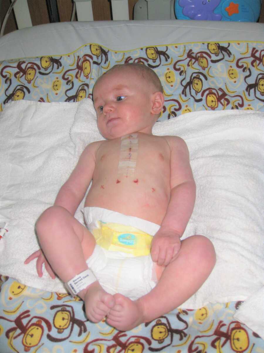 Baby Bennett and his post-surgery scars. 
