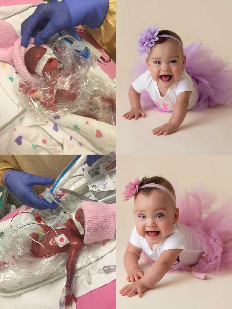 collage of premature twins in the hospital fighting to survive and then growing