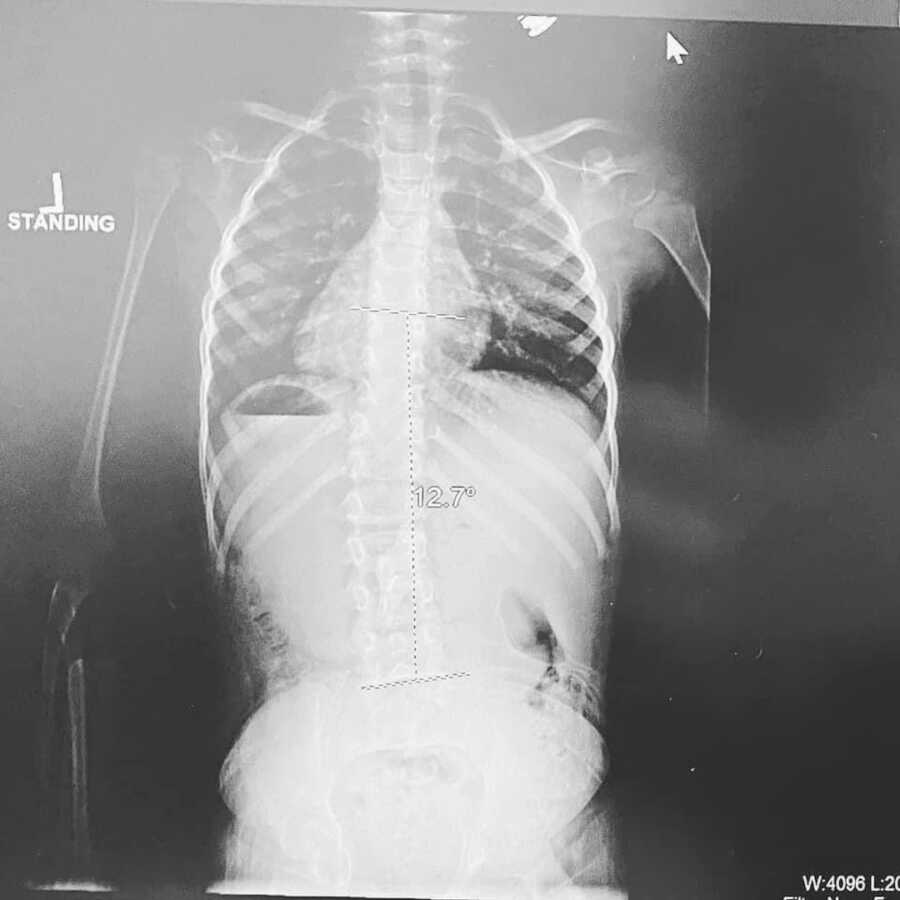 x-ray of boys body
