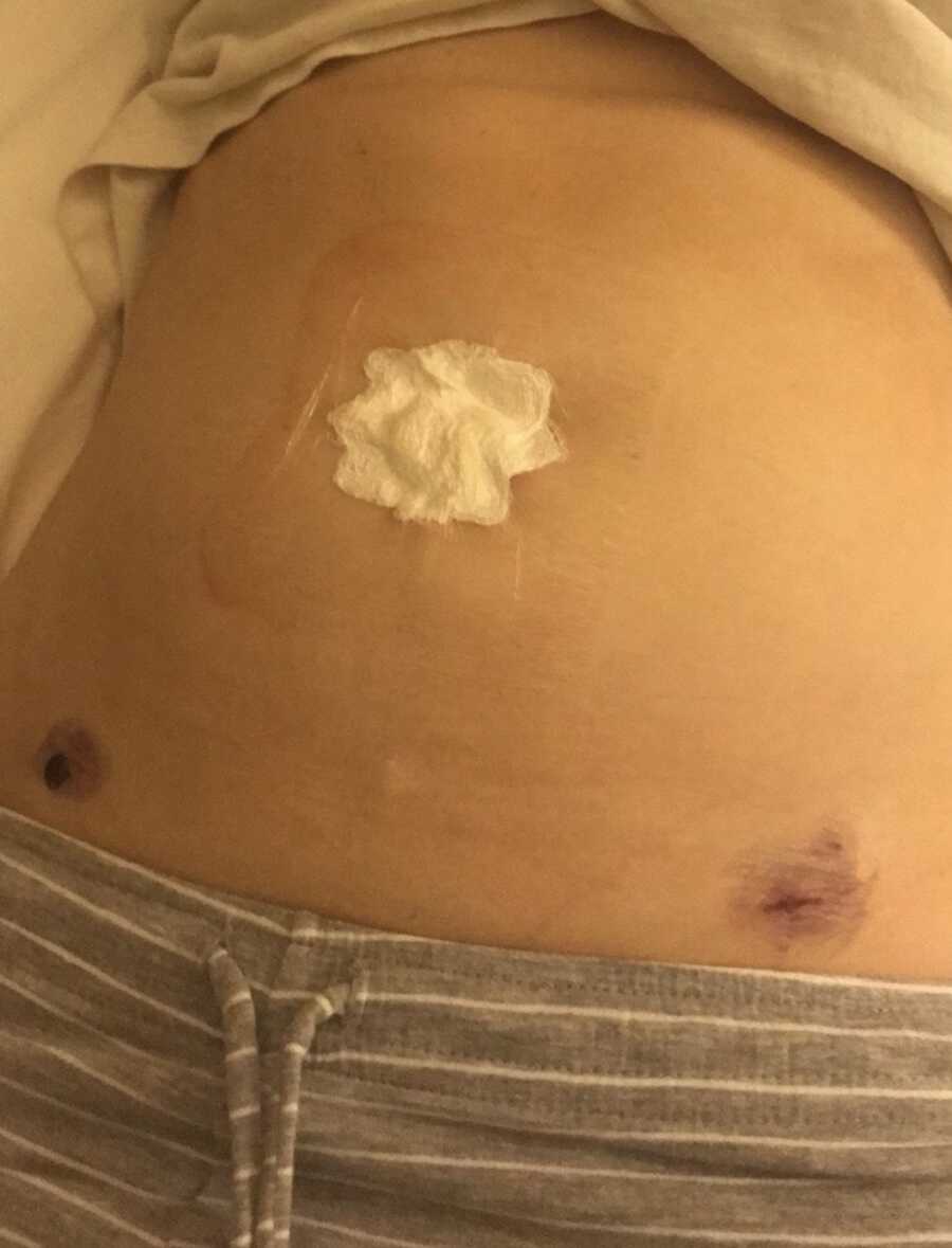 woman with bandage on stomach