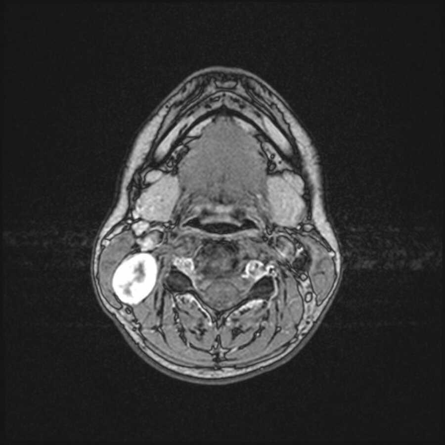 MRI of tumor that is causing pain