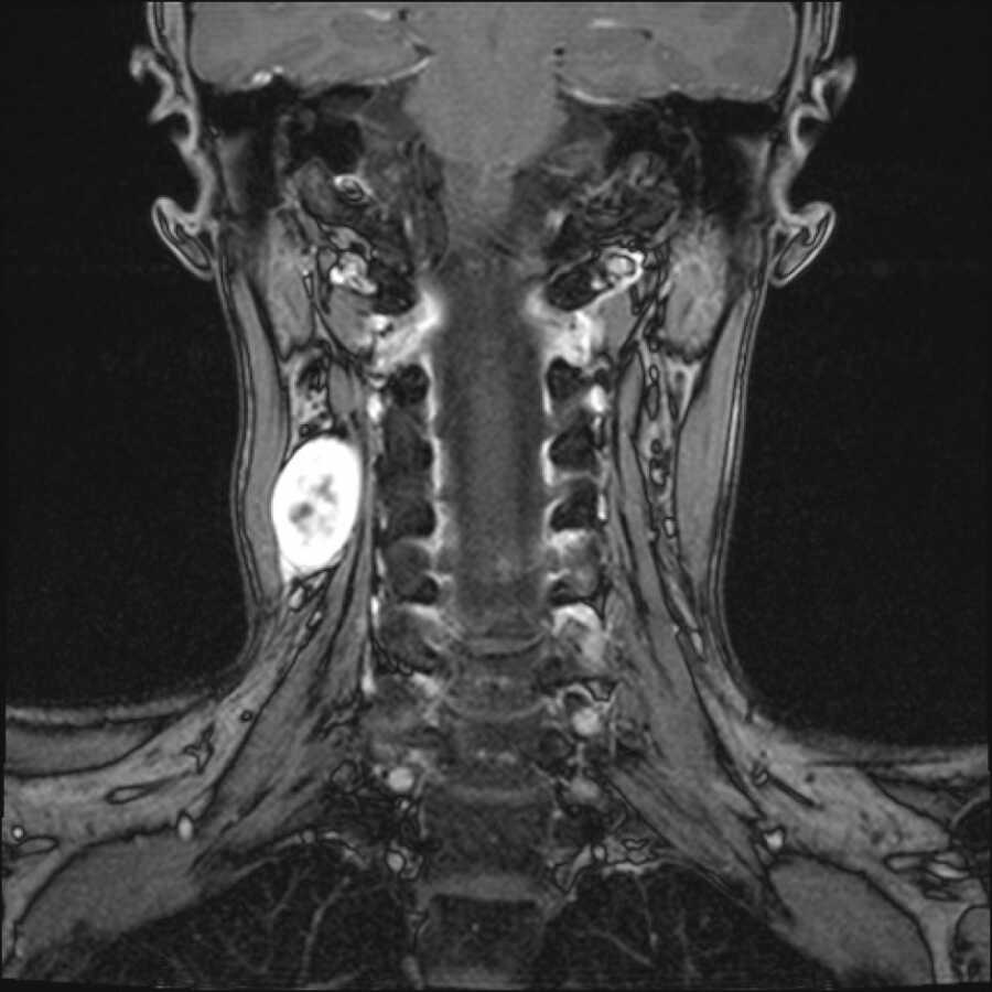 MRI of tumor that is causing pain