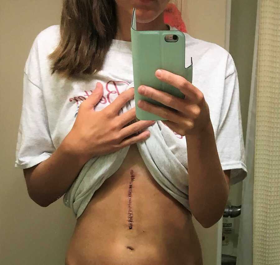 Young woman takes a mirror selfie of the six-inch scar down her abdomen from surgery