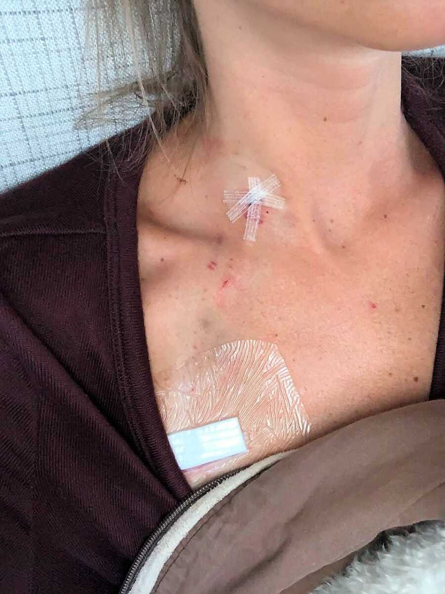 Woman battling chronic pain gets a central line put into her chest