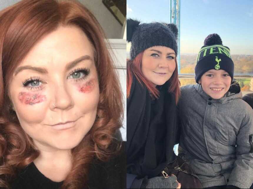 woman with lupus and butterfly rash, mom with her two sons