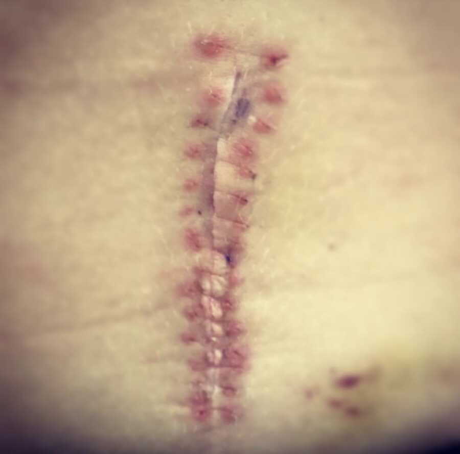 surgery scar