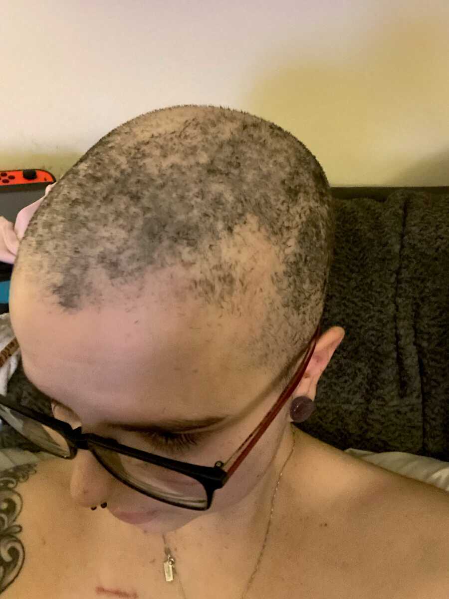 breast cancer warrior showing hair loss due to chemo