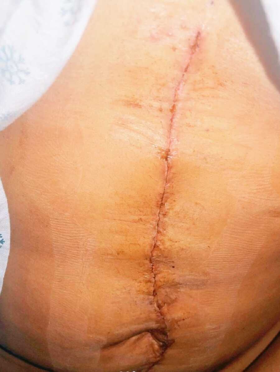 A scar from a surgical incision on a woman's stomach