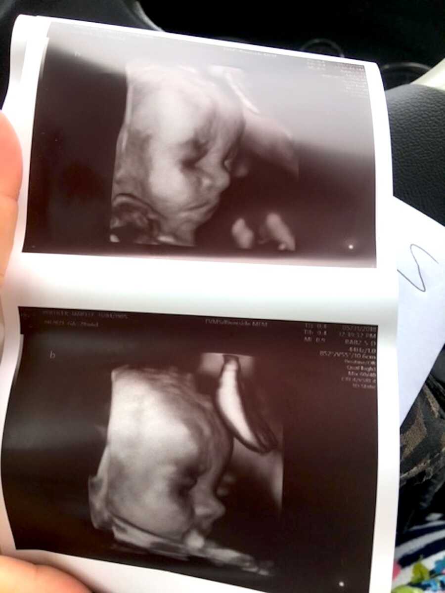ultrasound scans from a pregnancy with twins