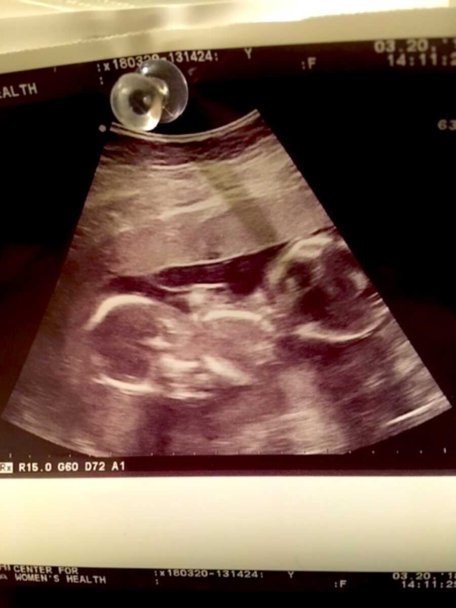 ultrasound scan from pregnancy with twins