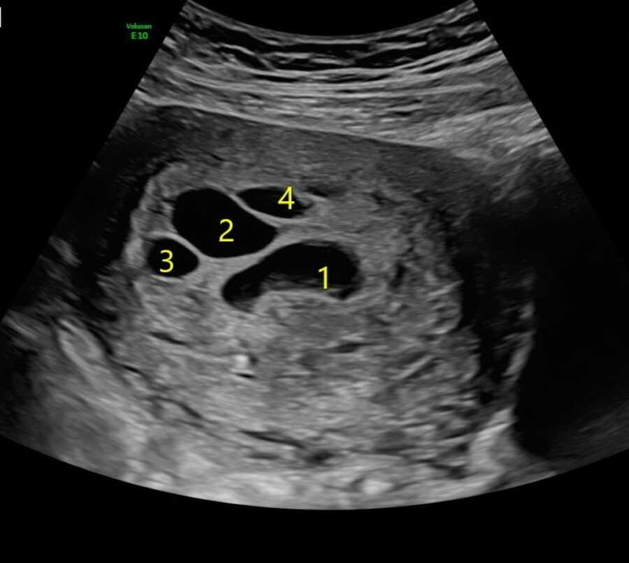 the sac of cysts in a woman's uterus 