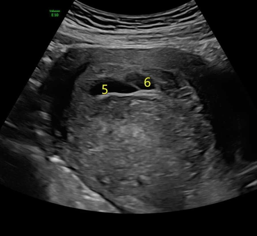 the sac of cysts in a woman's uterus 