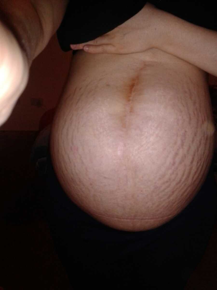 pregnant belly of a survivor