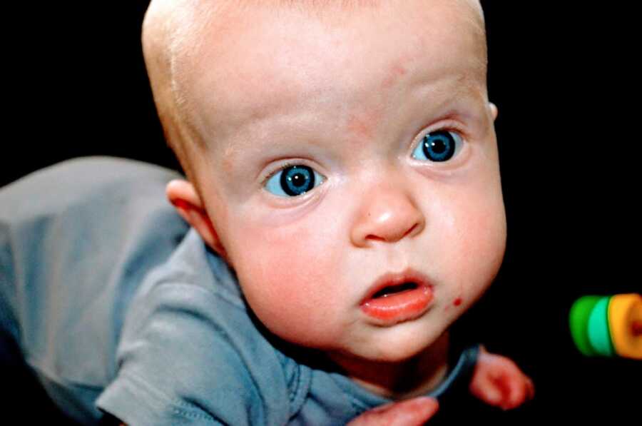 Baby girl with dwarfism stares into the camera with wide blue eyes