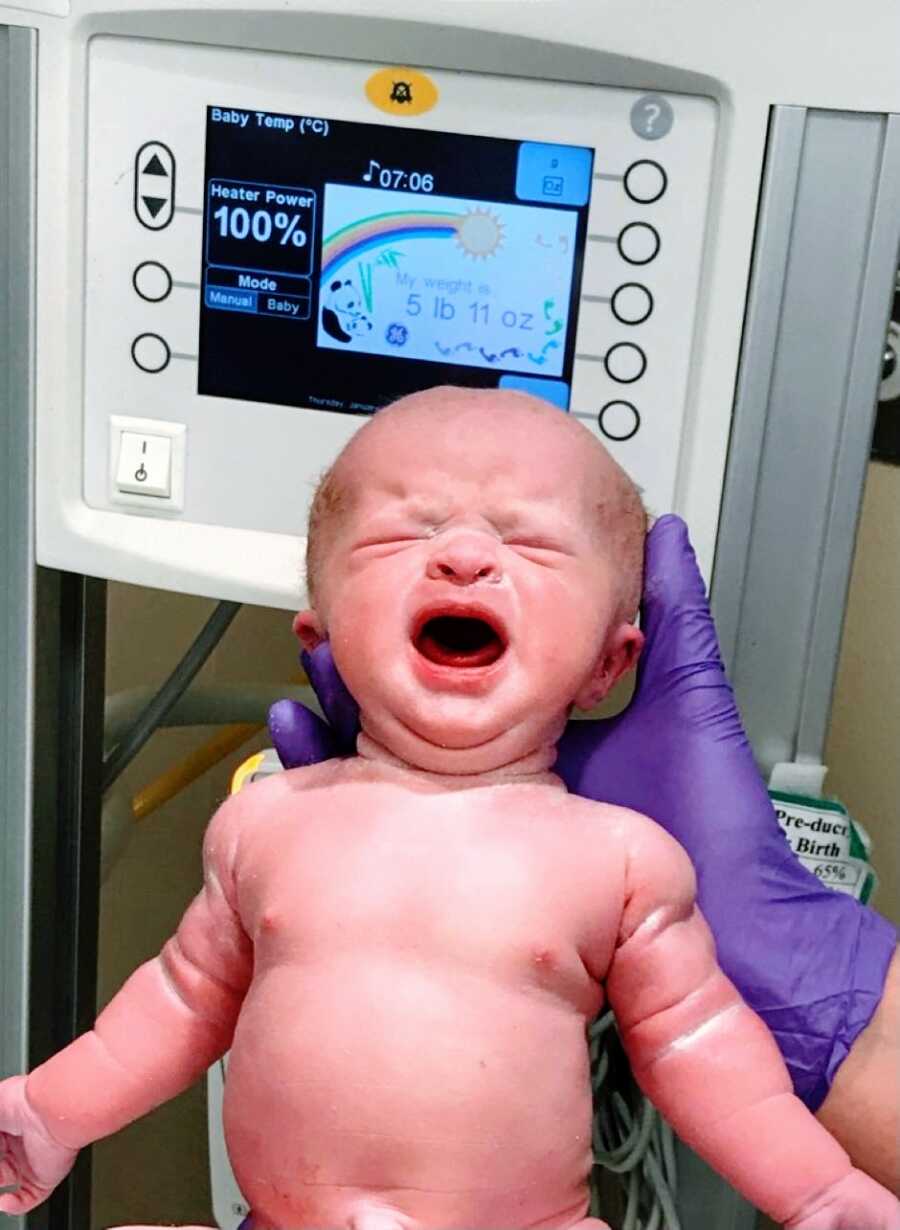 Newborn baby with achondroplasia cries while a doctor holds her