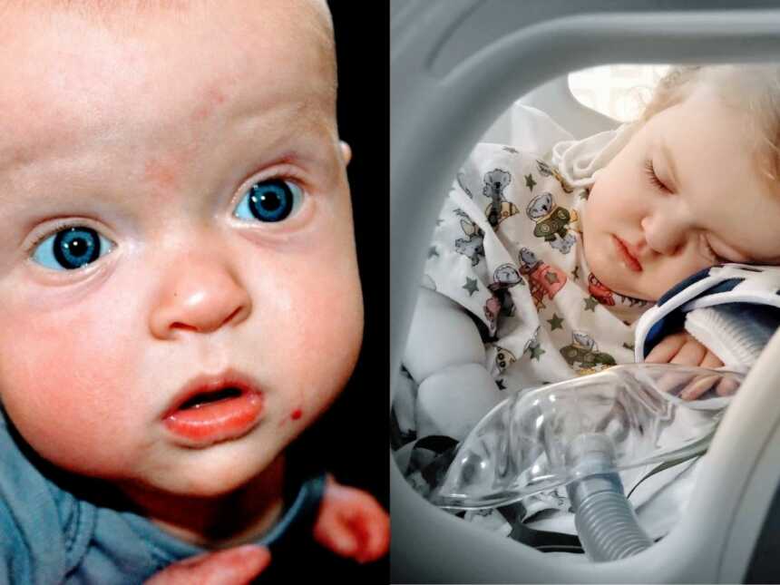 On the left, baby with dwarfism stares into the camera. On the right, same girl sleeps in the hospital.