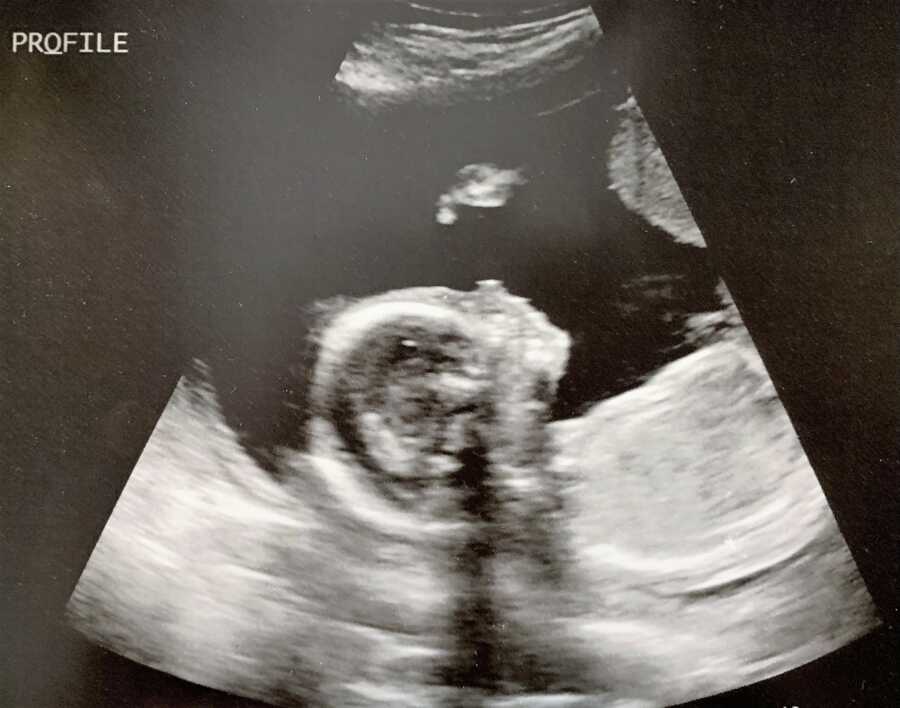 ultrasound of 20 weeks 