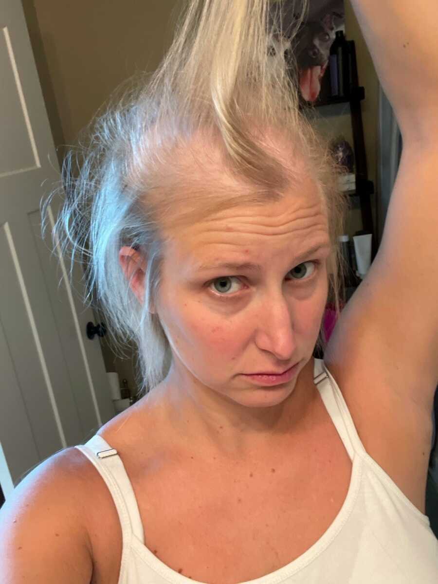 mom losing hair due to cancer
