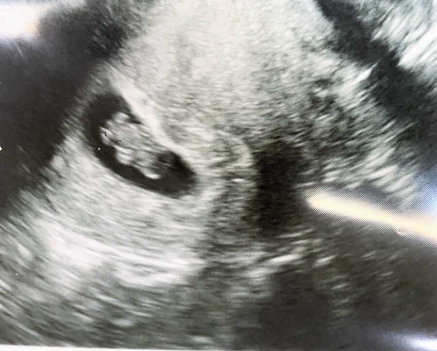 Ultrasound of rainbow baby after miscarriage due to ectopic pregnancy