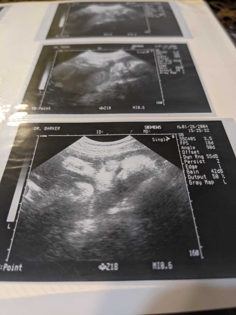 ultrasound photos showing pregnancy
