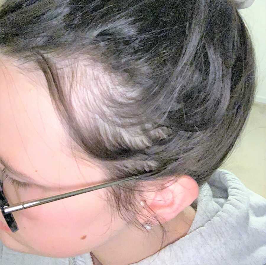 close up of postpartum mom's hair receding 