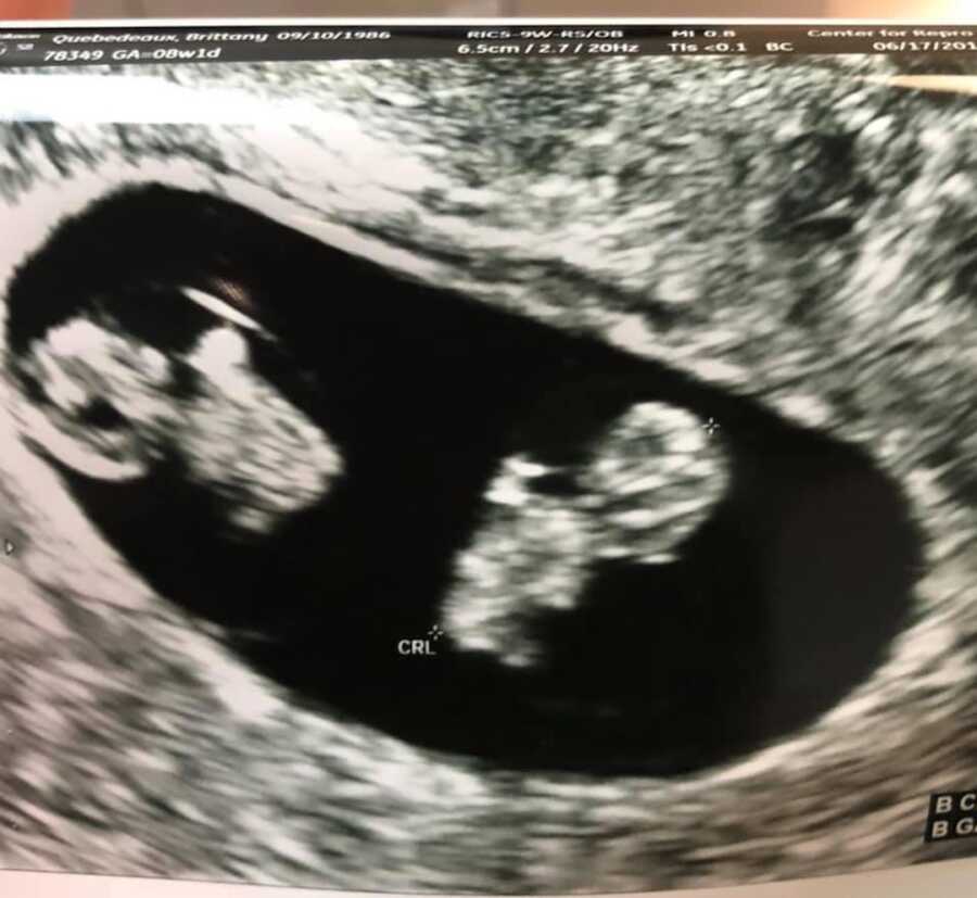 ultrasound image showing twins after infertility struggles