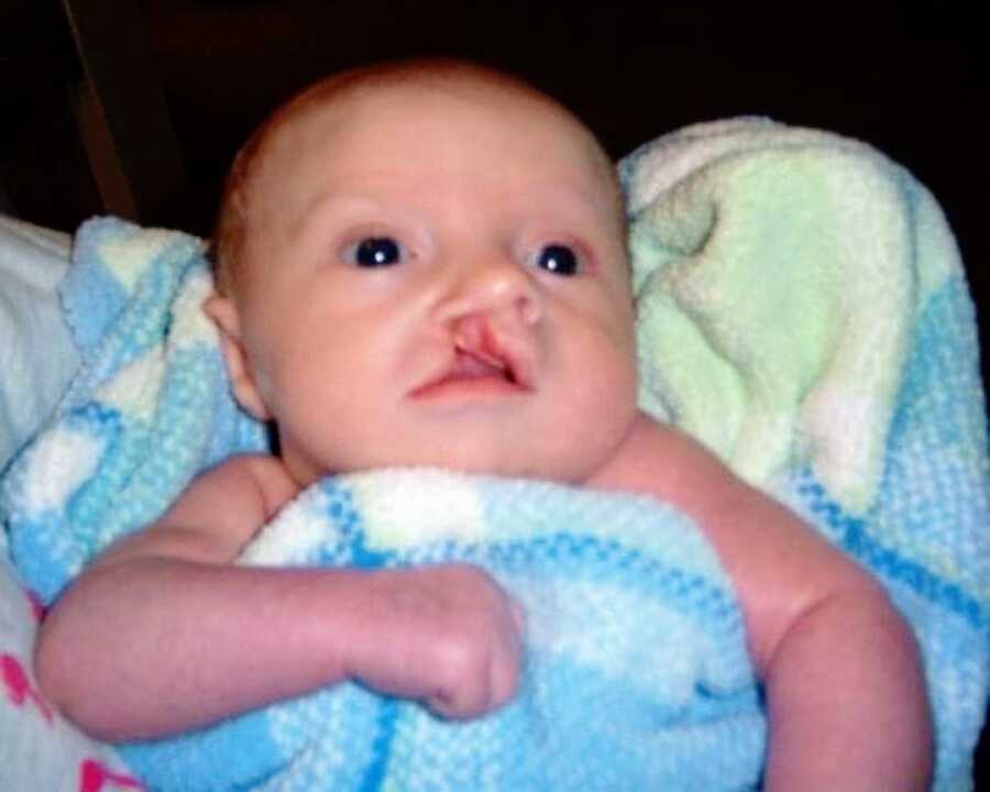 newborn baby boy with cleft lip sits wrapped in a blanket