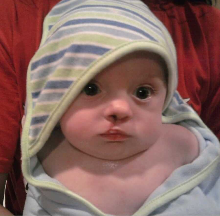 young baby boy with a cleft lip wrapped in a towel after a bath