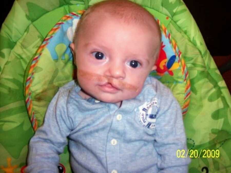 baby photo of young boy with a cleft lip, he stares into the camera